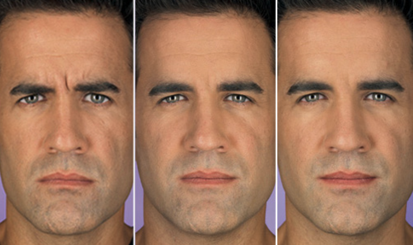Botox for men