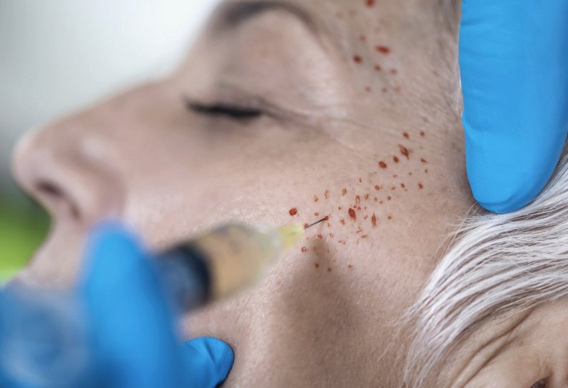 PRP Facial
