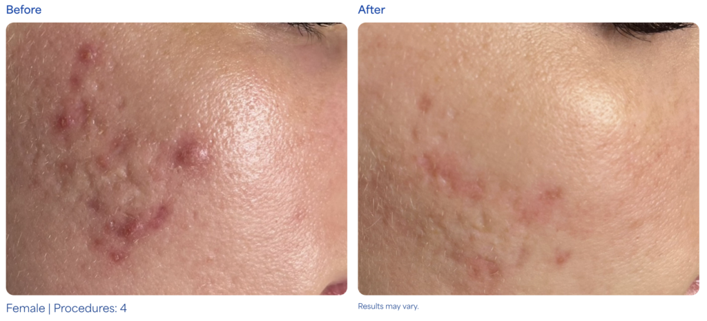MICRONEEDLING before after