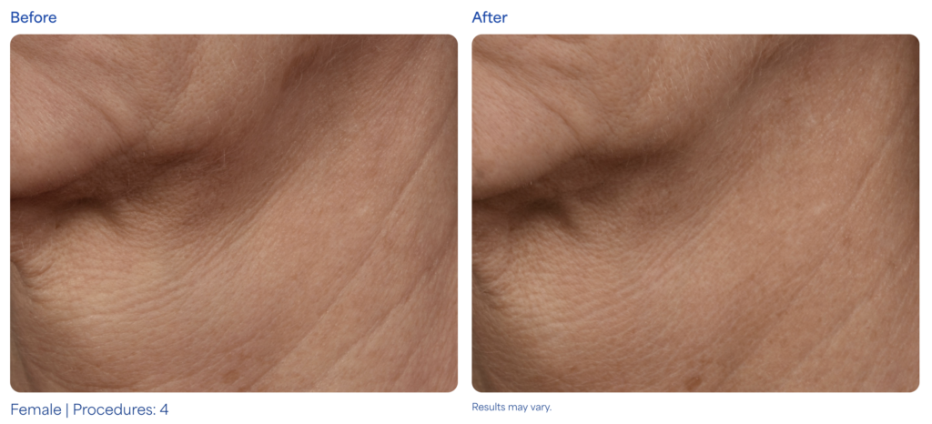 MICRONEEDLING before after