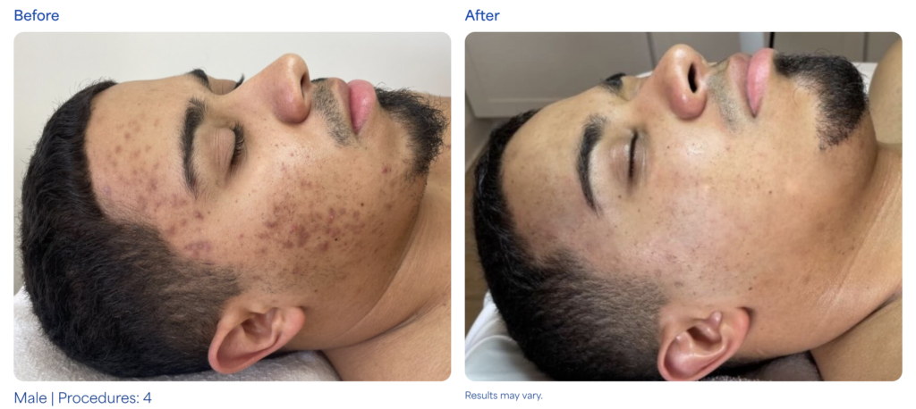 MICRONEEDLING before after