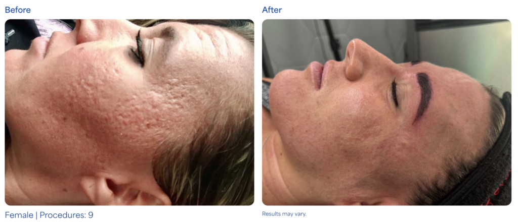 MICRONEEDLING before after