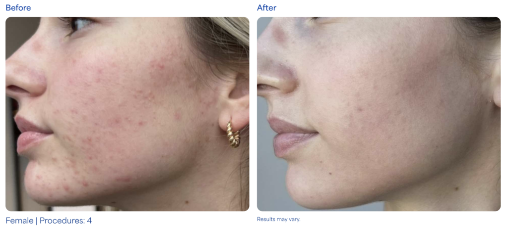 MICRONEEDLING before after
