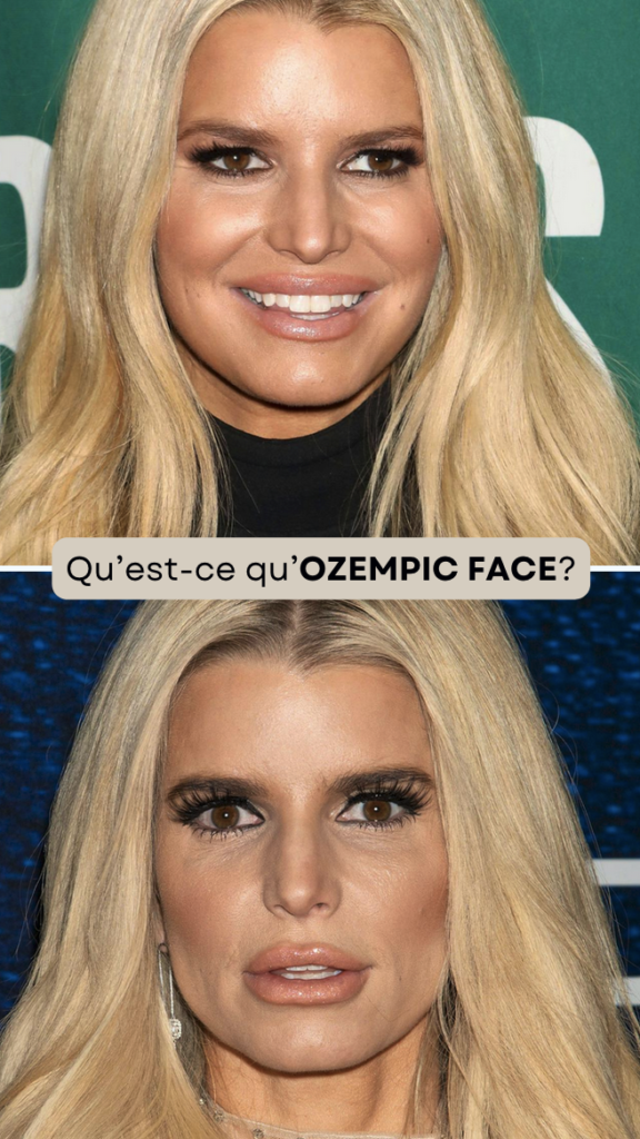 Femme concernée par la perte de volume facial liée à Ozempic – éviter l’ozempic face