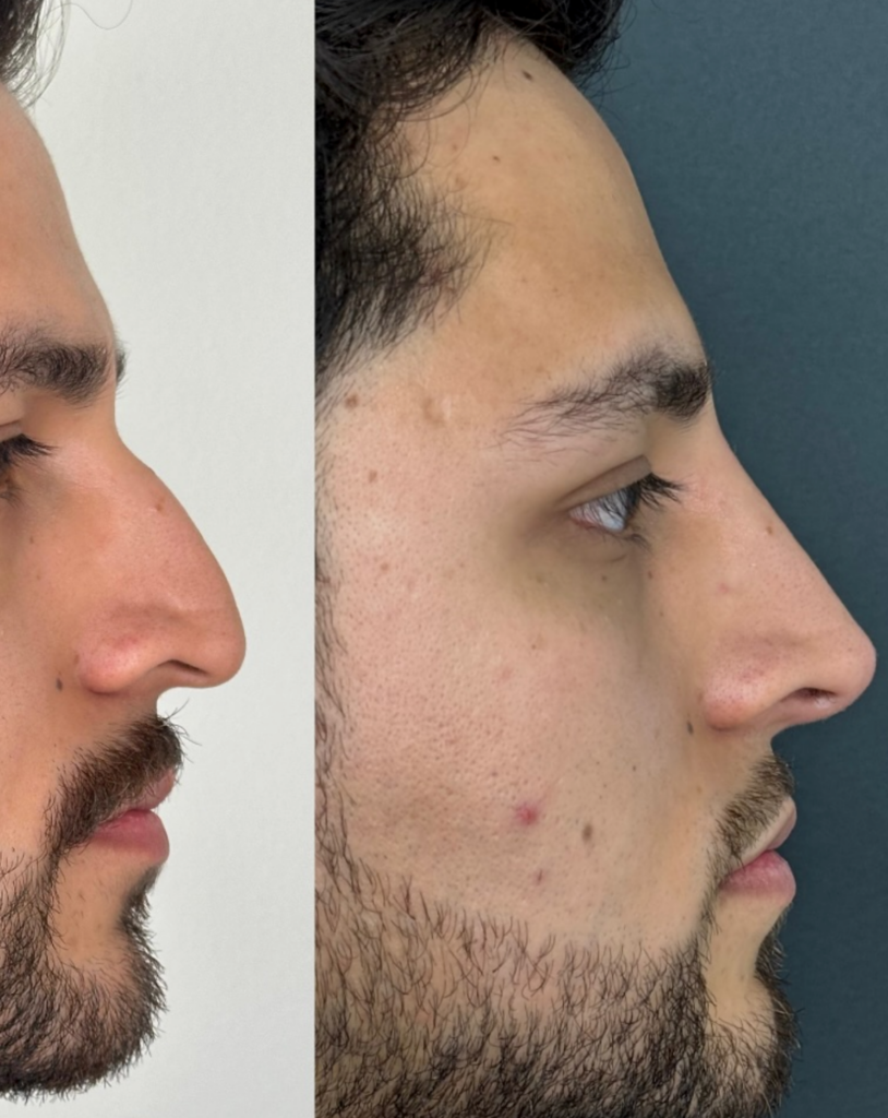 harmonisation du visage homme