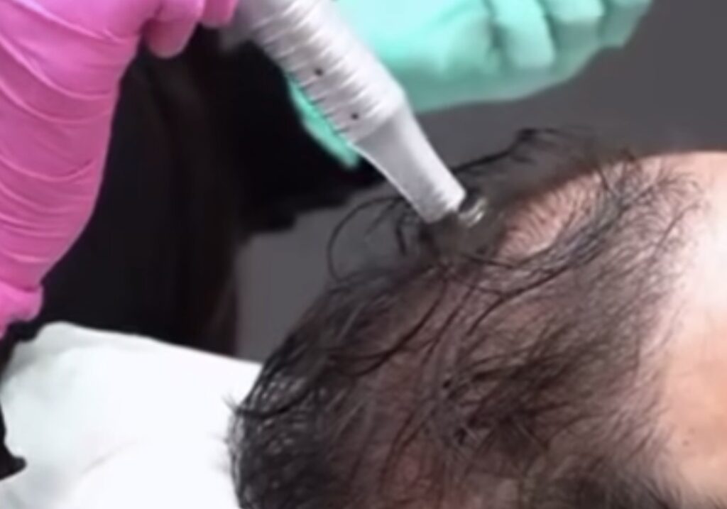 Hair Microneedling Finesse Institute