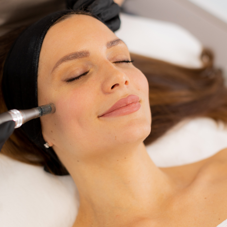 Microneedling Lausanne